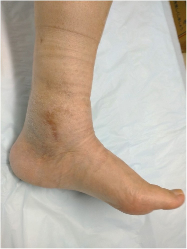 swollen foot behind medial malleolus due to tarsal tunnel