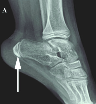 foot X-ray showing sever disease